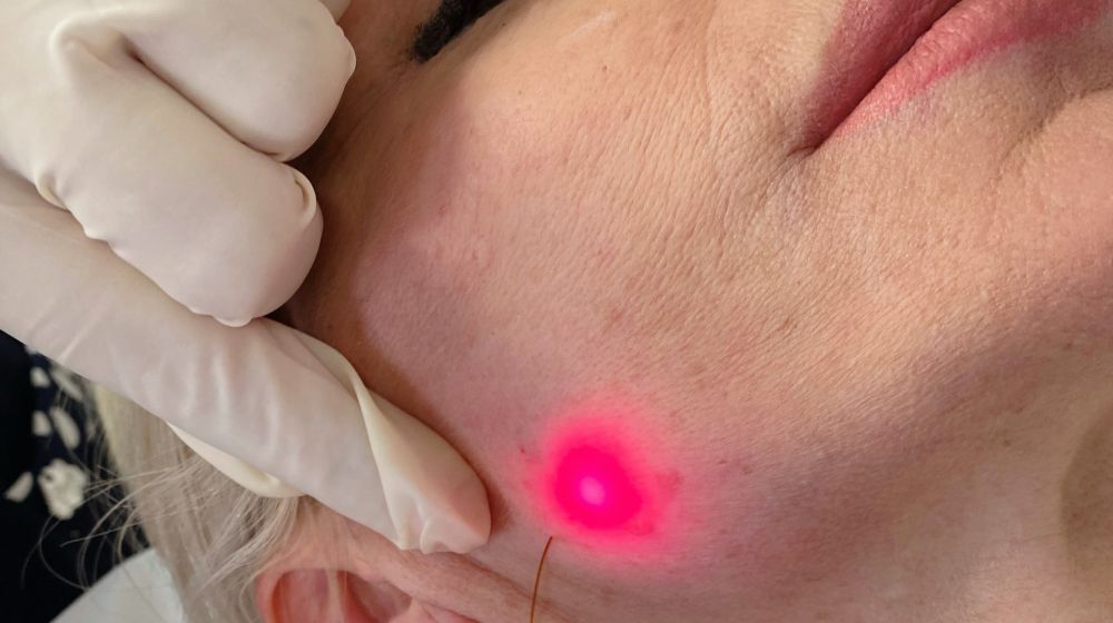 Endolift lezer